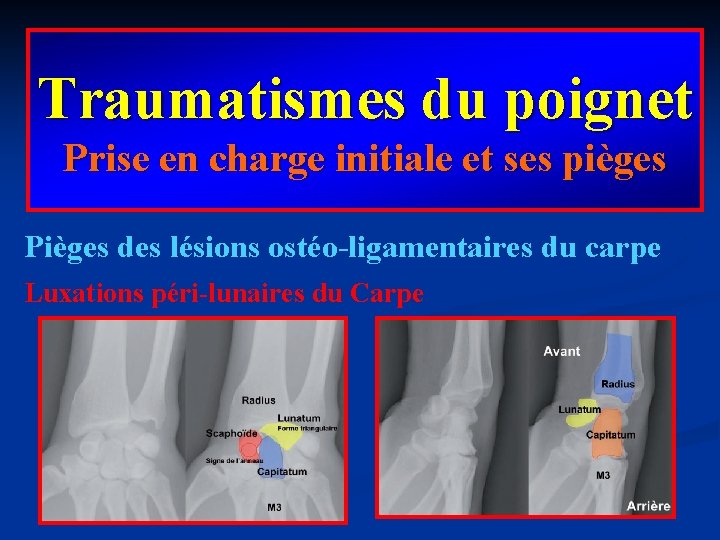 Traumatismes du poignet Prise en charge initiale et ses pièges Pièges des lésions ostéo-ligamentaires