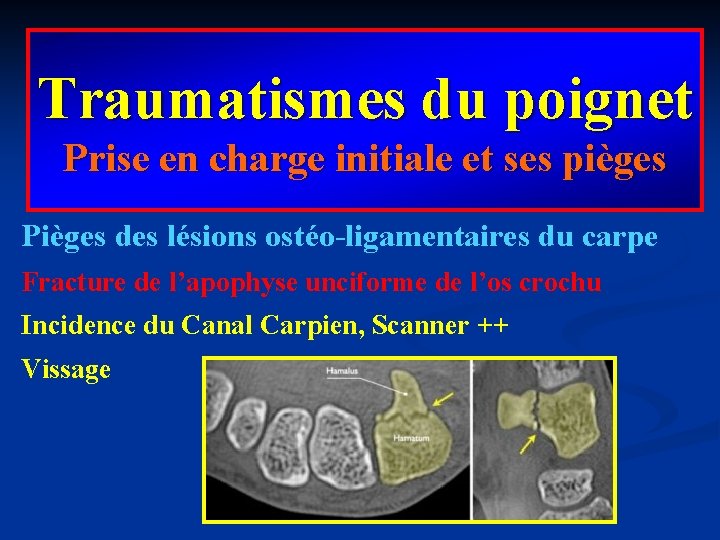 Traumatismes du poignet Prise en charge initiale et ses pièges Pièges des lésions ostéo-ligamentaires