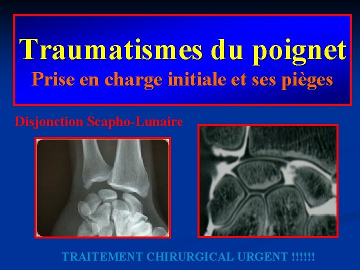 Traumatismes du poignet Prise en charge initiale et ses pièges Disjonction Scapho-Lunaire TRAITEMENT CHIRURGICAL