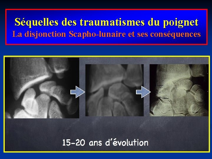 Séquelles des traumatismes du poignet La disjonction Scapho-lunaire et ses conséquences 