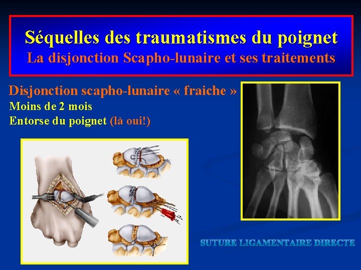 Séquelles des traumatismes du poignet La disjonction Scapho-lunaire et ses traitements Disjonction scapho-lunaire «