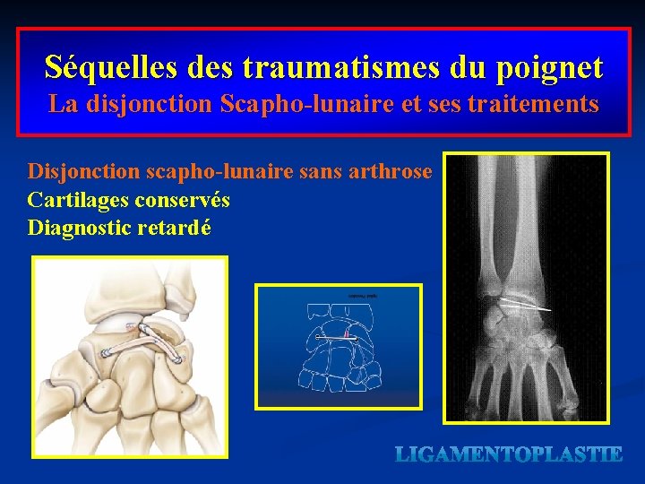 Séquelles des traumatismes du poignet La disjonction Scapho-lunaire et ses traitements Disjonction scapho-lunaire sans