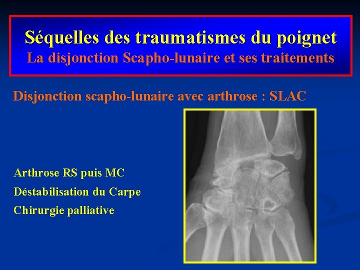 Séquelles des traumatismes du poignet La disjonction Scapho-lunaire et ses traitements Disjonction scapho-lunaire avec
