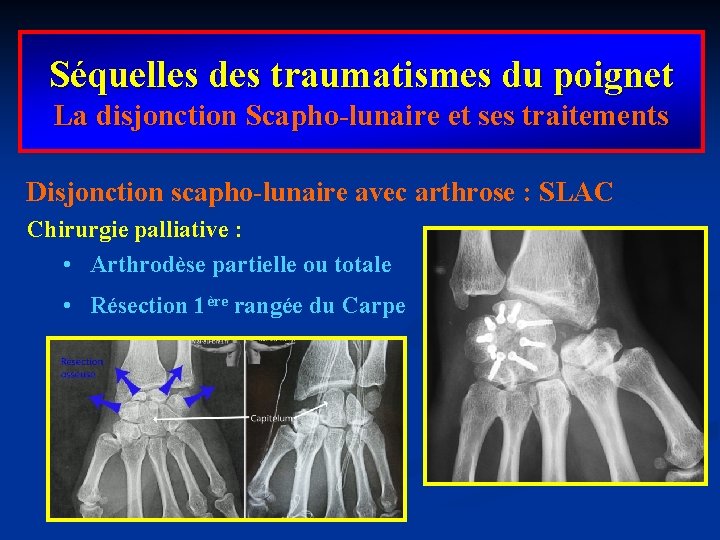 Séquelles des traumatismes du poignet La disjonction Scapho-lunaire et ses traitements Disjonction scapho-lunaire avec