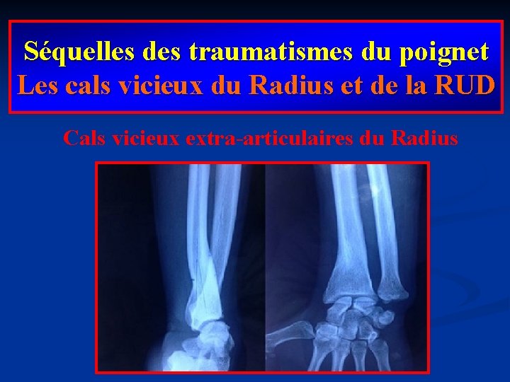 Séquelles des traumatismes du poignet Les cals vicieux du Radius et de la RUD