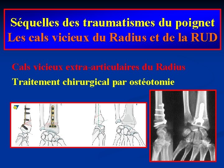 Séquelles des traumatismes du poignet Les cals vicieux du Radius et de la RUD
