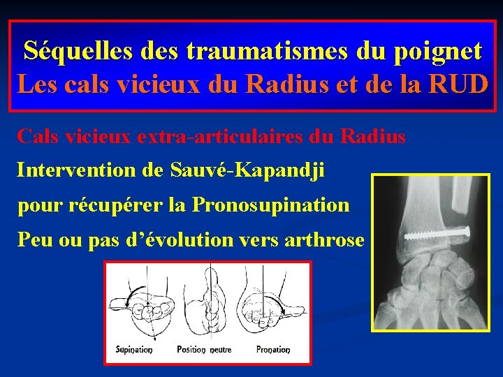 Séquelles des traumatismes du poignet Les cals vicieux du Radius et de la RUD