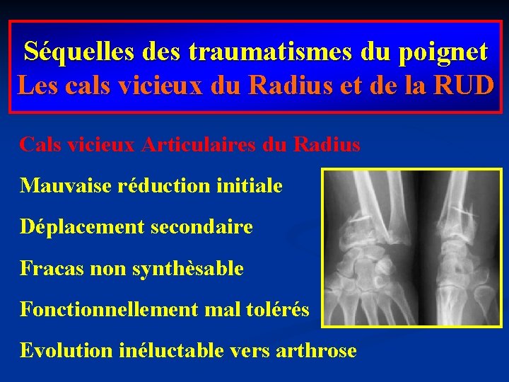 Séquelles des traumatismes du poignet Les cals vicieux du Radius et de la RUD