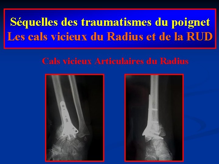 Séquelles des traumatismes du poignet Les cals vicieux du Radius et de la RUD