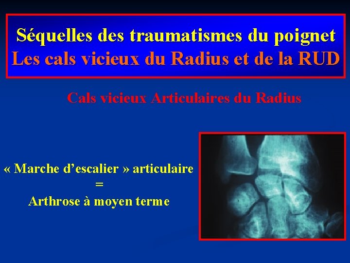 Séquelles des traumatismes du poignet Les cals vicieux du Radius et de la RUD