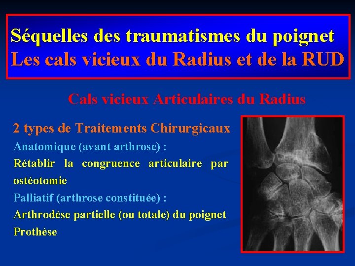 Séquelles des traumatismes du poignet Les cals vicieux du Radius et de la RUD