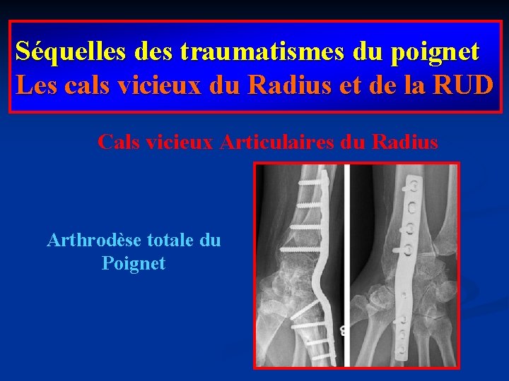 Séquelles des traumatismes du poignet Les cals vicieux du Radius et de la RUD