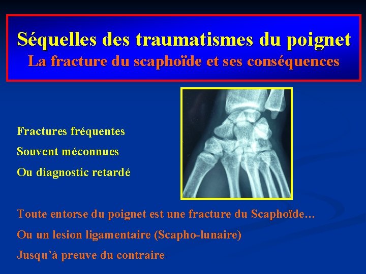Séquelles des traumatismes du poignet La fracture du scaphoïde et ses conséquences Fractures fréquentes