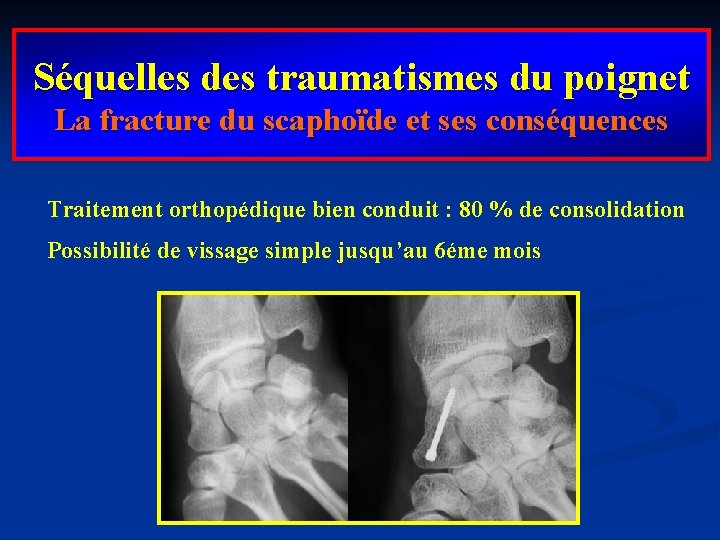 Séquelles des traumatismes du poignet La fracture du scaphoïde et ses conséquences Traitement orthopédique
