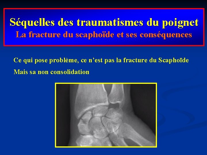 Séquelles des traumatismes du poignet La fracture du scaphoïde et ses conséquences Ce qui