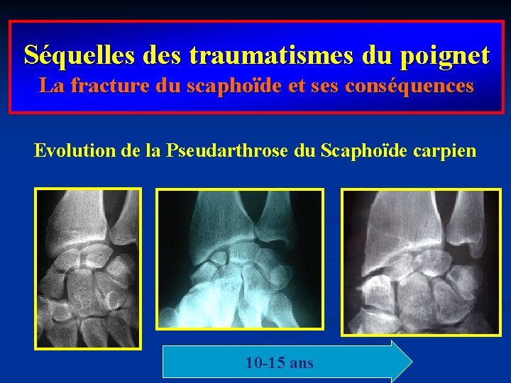 Séquelles des traumatismes du poignet La fracture du scaphoïde et ses conséquences Evolution de