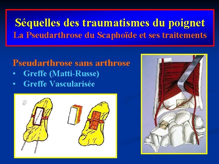 Séquelles des traumatismes du poignet La Pseudarthrose du Scaphoïde et ses traitements Pseudarthrose sans