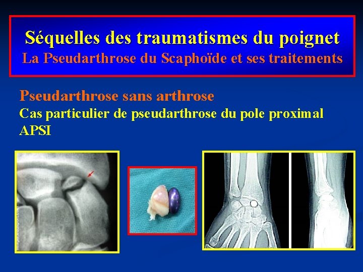 Séquelles des traumatismes du poignet La Pseudarthrose du Scaphoïde et ses traitements Pseudarthrose sans