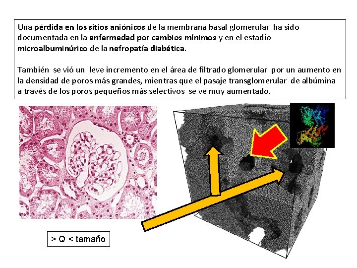 Una pérdida en los sitios aniónicos de la membrana basal glomerular ha sido documentada