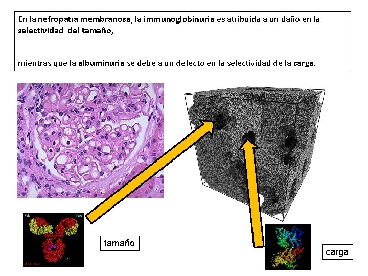 En la nefropatía membranosa, la immunoglobinuria es atribuida a un daño en la selectividad