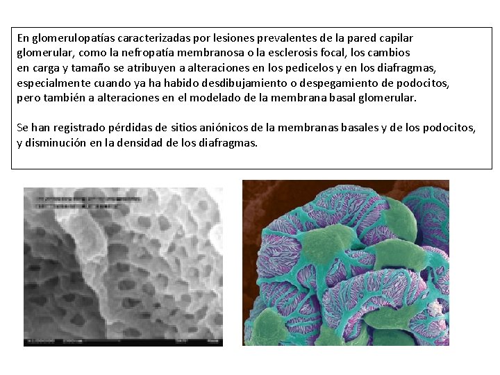 En glomerulopatías caracterizadas por lesiones prevalentes de la pared capilar glomerular, como la nefropatía