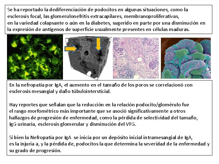 Se ha reportado la dediferenciación de podocitos en algunas situaciones, como la esclerosis focal,