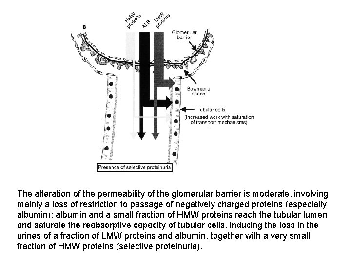 The alteration of the permeability of the glomerular barrier is moderate, involving mainly a