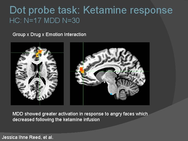 Dot probe task: Ketamine response HC: N=17 MDD N=30 Group x Drug x Emotion Dot probe task: Ketamine response HC: N=17 MDD N=30 Group x Drug x Emotion