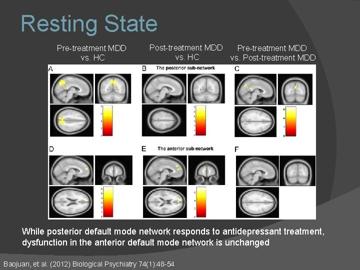 Resting State Pre-treatment MDD vs. HC Post-treatment MDD Pre-treatment MDD vs. HC vs. Post-treatment Resting State Pre-treatment MDD vs. HC Post-treatment MDD Pre-treatment MDD vs. HC vs. Post-treatment