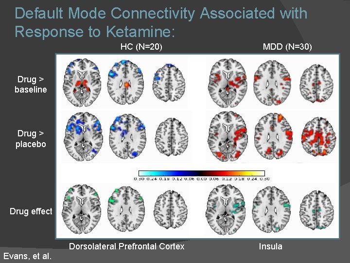 Default Mode Connectivity Associated with Response to Ketamine: HC (N=20) MDD (N=30) Drug > Default Mode Connectivity Associated with Response to Ketamine: HC (N=20) MDD (N=30) Drug >