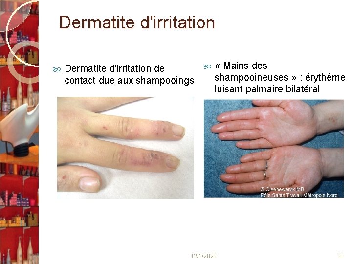 Dermatite d'irritation « Mains des Dermatite d'irritation de shampooineuses » : érythème contact due