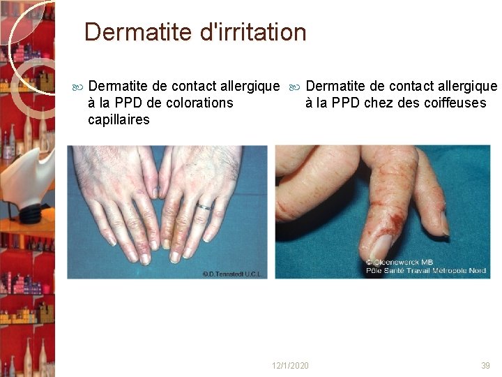 Dermatite d'irritation Dermatite de contact allergique à la PPD de colorations à la PPD