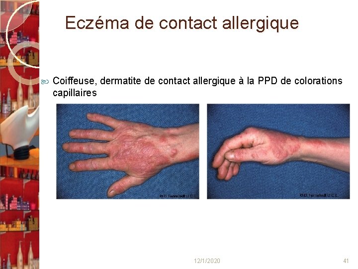  Eczéma de contact allergique Coiffeuse, dermatite de contact allergique à la PPD de