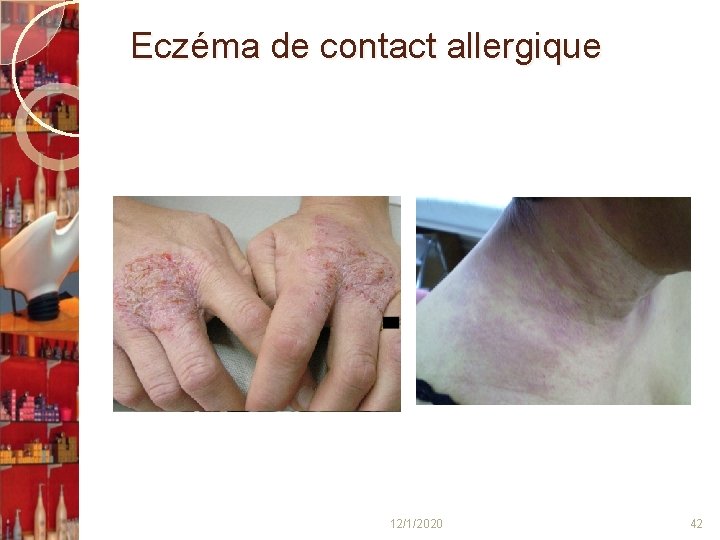  Eczéma de contact allergique 12/1/2020 42 