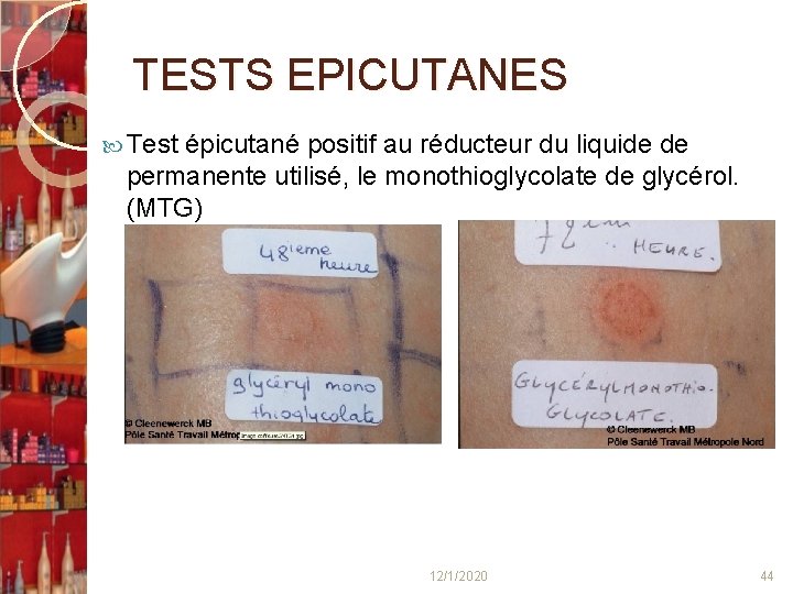 TESTS EPICUTANES Test épicutané positif au réducteur du liquide de permanente utilisé, le monothioglycolate