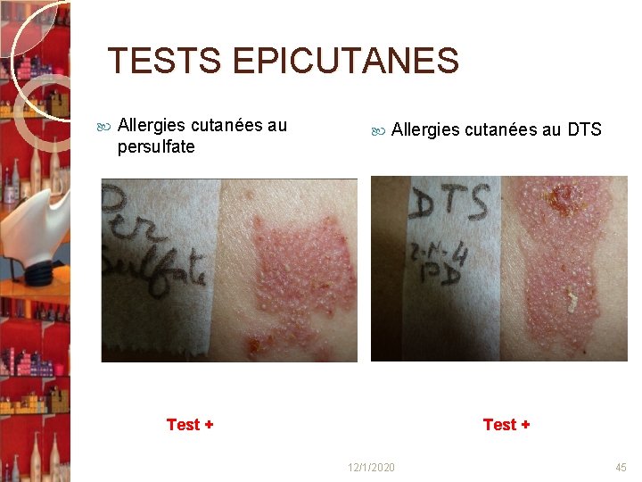 TESTS EPICUTANES Allergies cutanées au persulfate Allergies cutanées au DTS Test + 12/1/2020 45