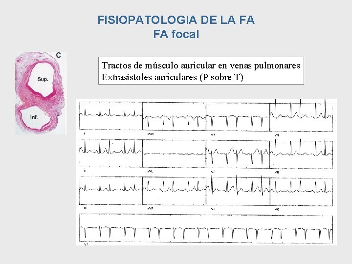 FISIOPATOLOGIA DE LA FA FA focal Tractos de músculo auricular en venas pulmonares Extrasístoles