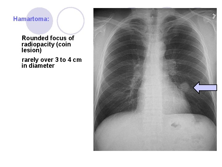 Hamartoma: Rounded focus of radiopacity (coin lesion) rarely over 3 to 4 cm in Hamartoma: Rounded focus of radiopacity (coin lesion) rarely over 3 to 4 cm in