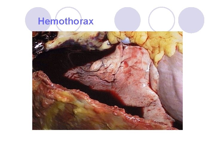 Hemothorax Hemothorax