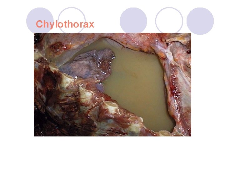 Chylothorax Chylothorax