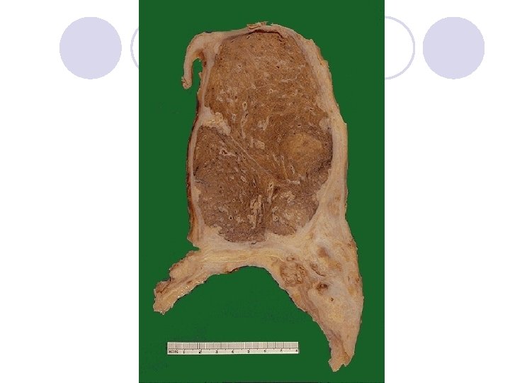 mutations in malignant mesothelioma