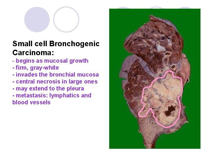 Small cell Bronchogenic Carcinoma: - begins as mucosal growth - firm, gray-white - invades Small cell Bronchogenic Carcinoma: - begins as mucosal growth - firm, gray-white - invades