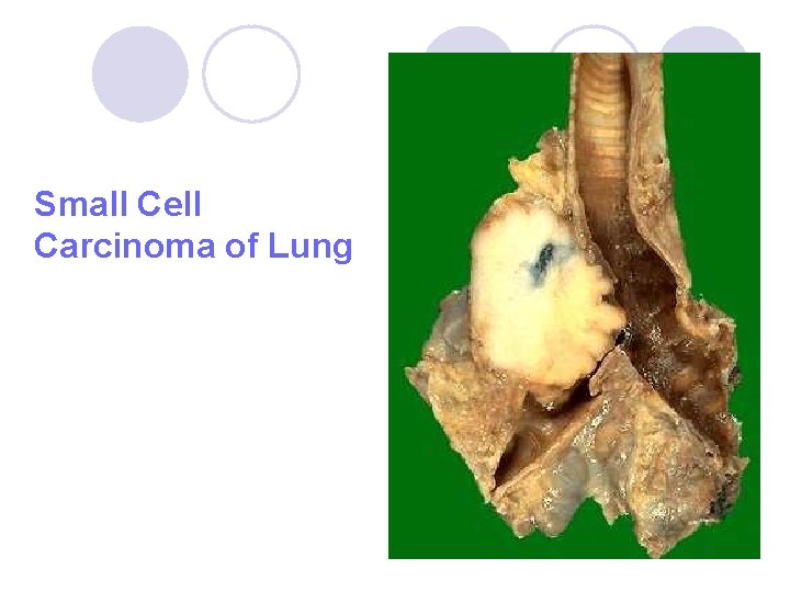 Small Cell Carcinoma of Lung Small Cell Carcinoma of Lung