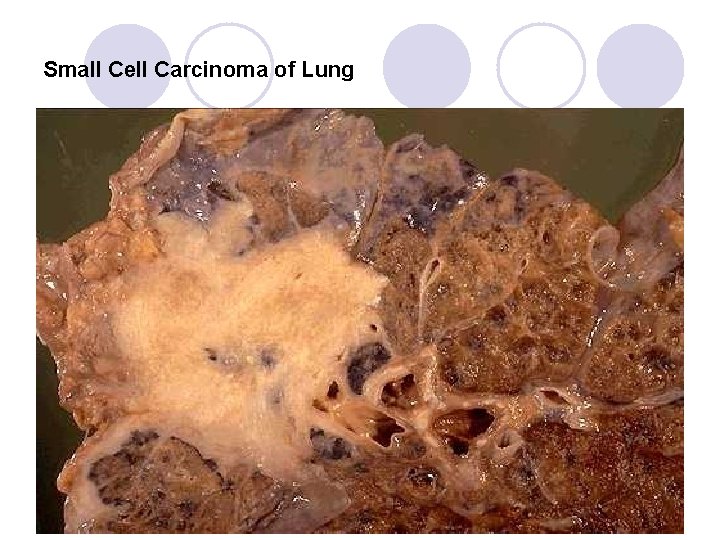 Small Cell Carcinoma of Lung Small Cell Carcinoma of Lung