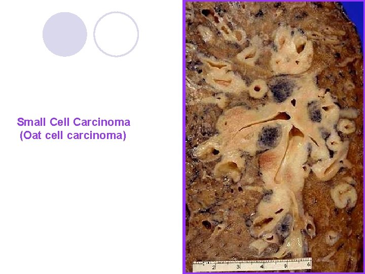Small Cell Carcinoma (Oat cell carcinoma) Small Cell Carcinoma (Oat cell carcinoma)