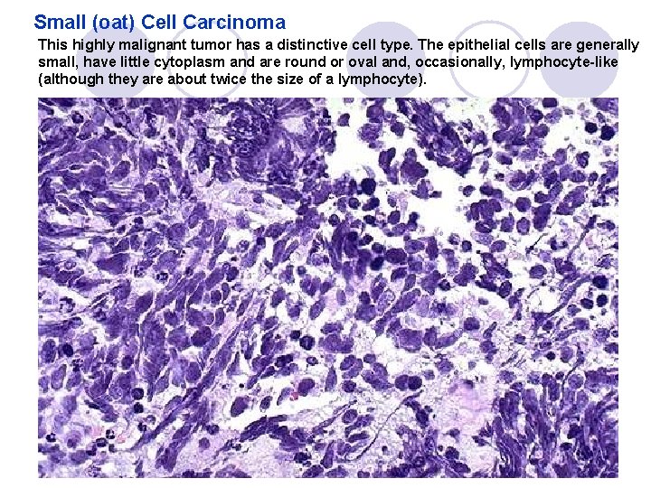 Small (oat) Cell Carcinoma This highly malignant tumor has a distinctive cell type. The Small (oat) Cell Carcinoma This highly malignant tumor has a distinctive cell type. The