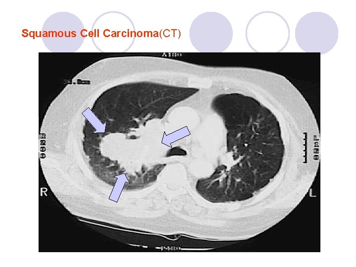 Squamous Cell Carcinoma(CT) Squamous Cell Carcinoma(CT)