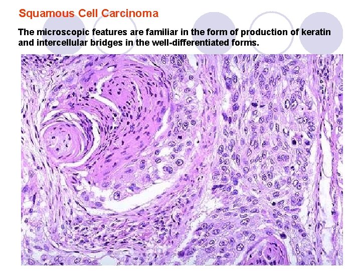 Squamous Cell Carcinoma The microscopic features are familiar in the form of production of Squamous Cell Carcinoma The microscopic features are familiar in the form of production of