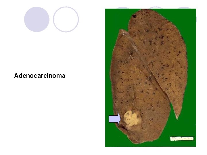 Adenocarcinoma Adenocarcinoma