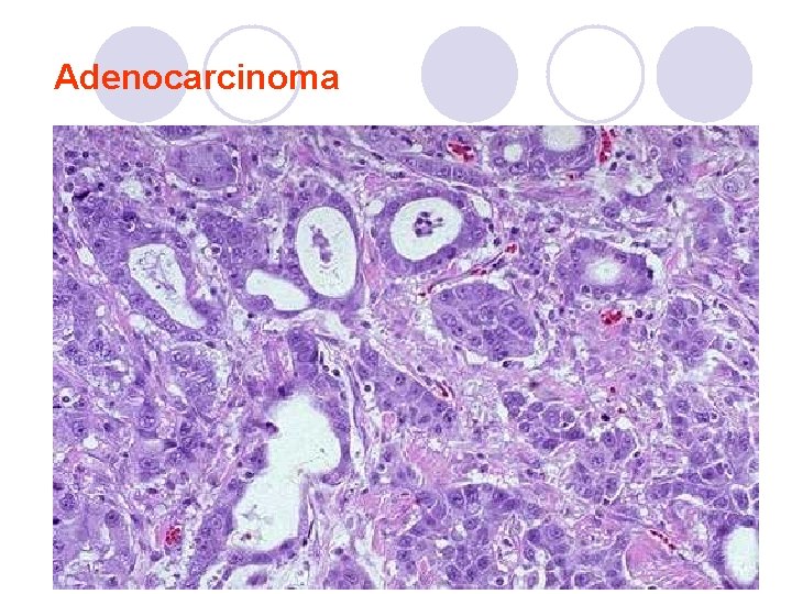Adenocarcinoma Adenocarcinoma